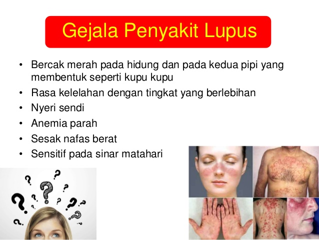Penyakit Lupus